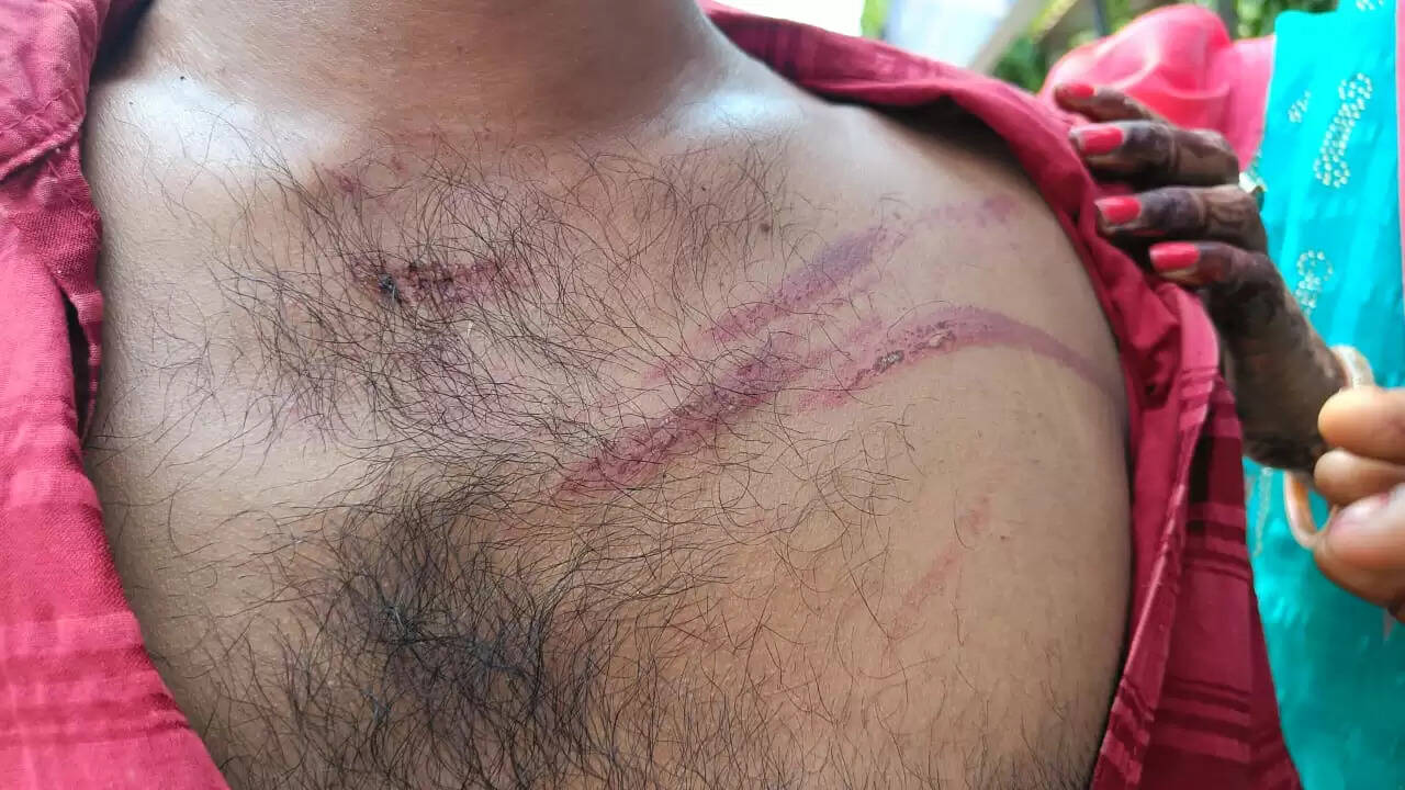 injured Ravi rajbhar