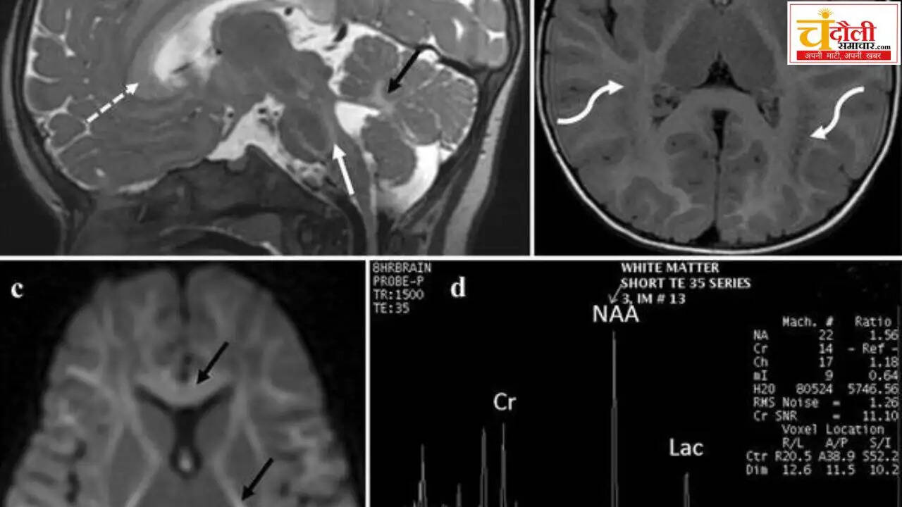 rare-brain-disease-children-bp-medicine-study
