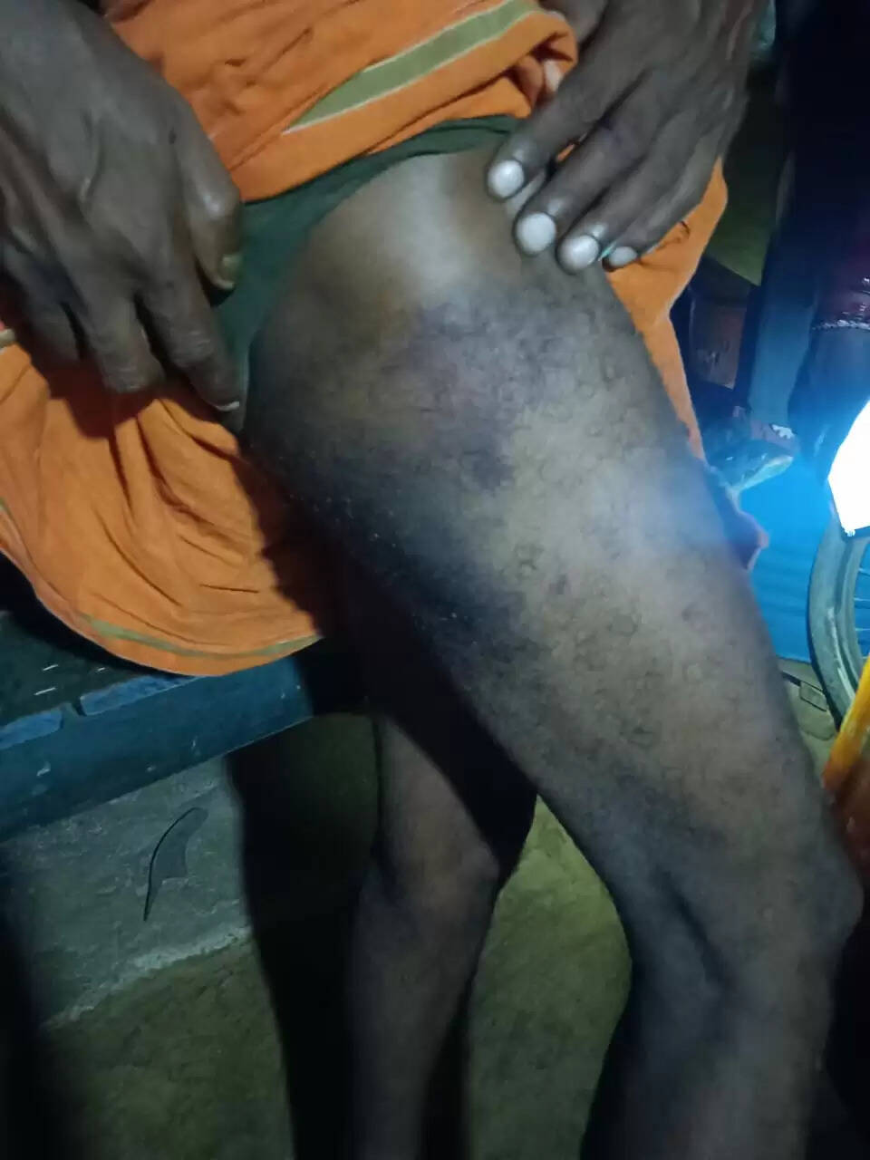 Beaten in Police Custody